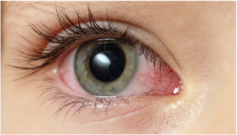 Dehydration And Dry Eye Symptoms